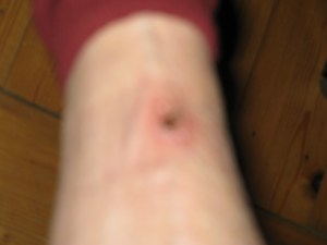 26-11-14 Isis & me leg wounds! 002